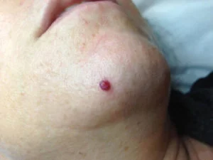 Cherry Angioma 1