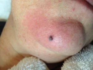 Cherry Angioma 2