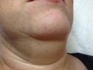 Cherry Angioma 3